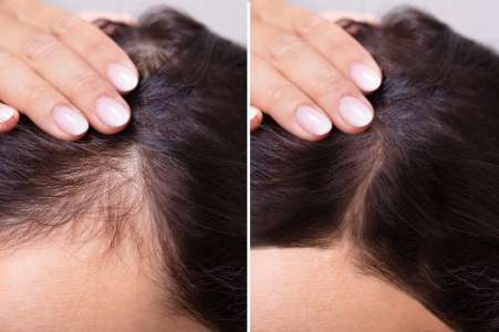 Le supplément de croissance des cheveux Viviscal aide les acheteurs à réduire la perte de cheveux