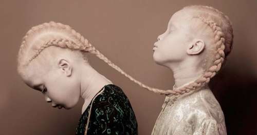 Le mannequinat est réputé pour ses stéréotypes, ces jumelles albinos y revendiquent leur différence