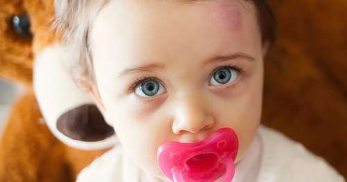 Une mère se maquille le visage pour imiter la tache de naissance de sa fille, en forme de cœur  