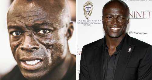 Seal porte depuis plus de 30 ans les cicatrices qui caractérisent son visage – voici pourquoi