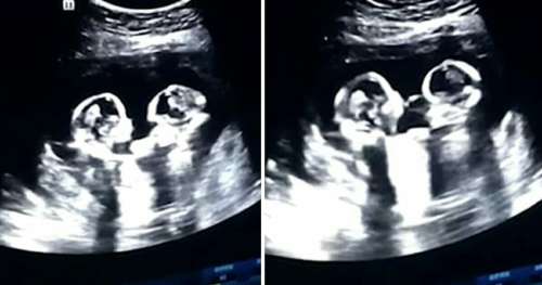 Le médecin ordonne à la mère de regarder de plus près l’échographie – voit des jumeaux se battre pour la première fois dans l’utérus
