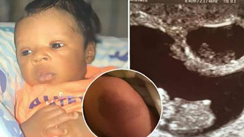 Un bébé « disparaît » de l’échographie et son jumeau naît avec une marque spéciale