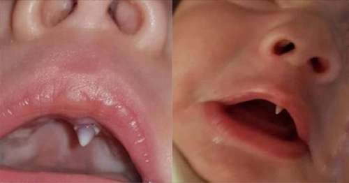 Un Bebe De 11 Semaines Fait Pousser Une Dent Canine En Une Nuit Sur Buzz Insolite Et Culture