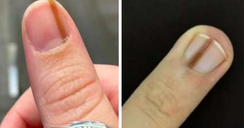 Pourquoi vous devez vous précipiter à l’hôpital si vous voyez une marque sur votre ongle – cette décision pourrait vous sauver la vie