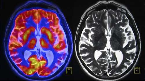 Covid-19 : cette étude montre que le virus peut infecter les cellules du cerveau humain