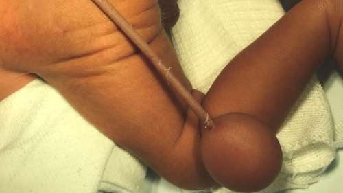 Un bébé humain né avec une véritable queue au Brésil