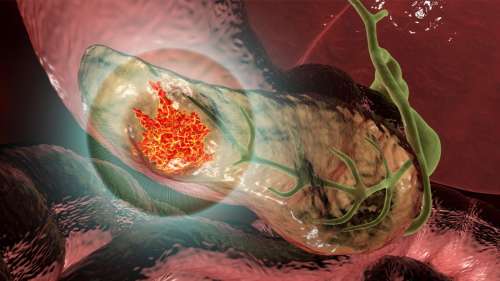 Cancer : un implant radioactif élimine les tumeurs dans un succès préclinique sans précédent