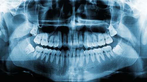 Le saviez-vous ? En Inde, un enfant s’est fait retirer 526 dents de la bouche