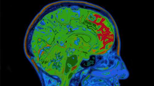 L’obésité entraine des changements irréversibles dans le cerveau, selon une étude