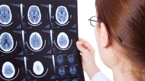 Cancer du cerveau : un nouveau traitement montre des résultats prometteurs contre le glioblastome