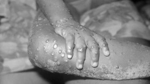 L’inquiétude monte autour du virus mpox : voici ce que l’on sait sur l’épidémie