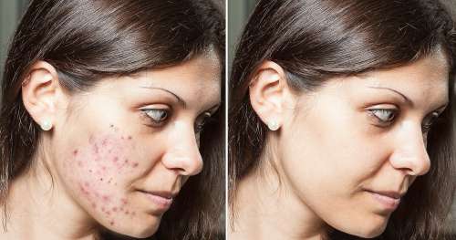 CeraVe 12 $ Le rétinol peut aider à éliminer les cicatrices d’acné et les pores visibles