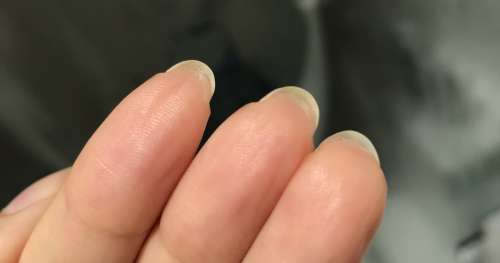 Raison de la croissance de la peau sous les ongles