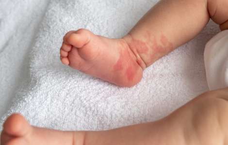 Les médecins prennent les taches de naissance de son bébé pour des bleus, elle en paie le prix fort