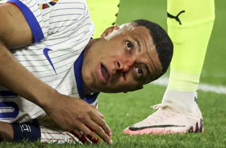 Kylian Mbappé blessé au nez : cette solution sur mesure pour son retour dans l'Euro 2024