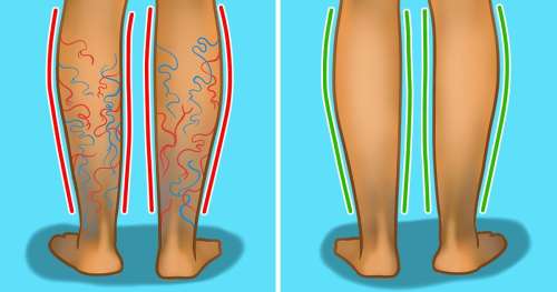 10 Manières de réduire ou d’éviter l’apparition des varices
