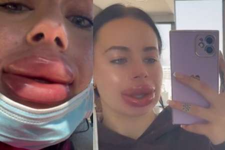 Mauvaise surprise pour une influenceuse : après une chirurgie esthétique, ses lèvres enflent fortement (VIDÉOS)