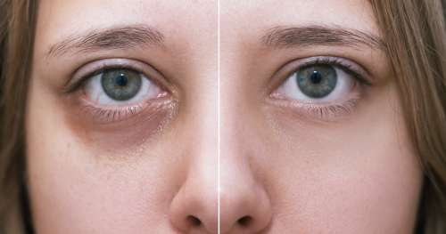 Goldfaden MD Eye Cream est le meilleur remède contre les cernes