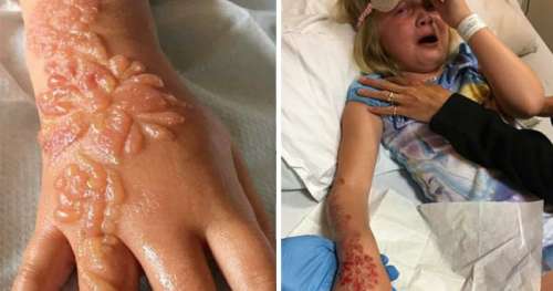 Une enfant de 7 ans se retrouve avec d’horribles ampoules, brulures et cicatrices après s’être fait tatouer au henné pendant ses vacances