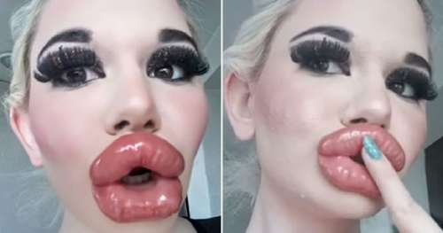 Andrea a subi plus de 20 augmentations des lèvres – pour avoir le plus grand « duck face » du monde