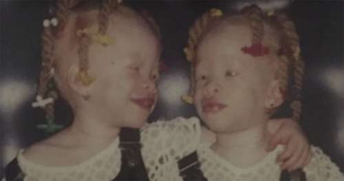 Personne ne voulait entendre parler des jumelles atteintes d’albinisme – Aujourd’hui, tout le monde s’étonne de leur réapparition 24 ans plus tard