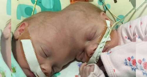 Des jumelles siamoises ont survécu à une intervention chirurgicale potentiellement mortelle. Voici à quoi elles ressemblent aujourd’hui