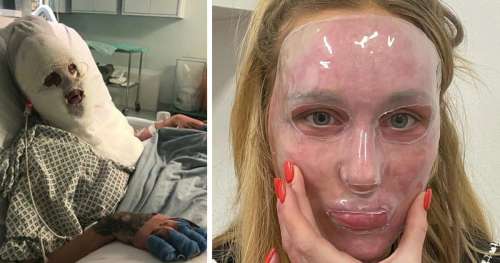 Une farce cruelle de ses amis a fait fondre le visage de cette femme – plus d’un an après, elle est complètement méconnaissable