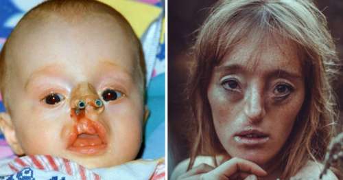 Ilka Brühl est née avec un défaut facial rare – aujourd’hui, elle brise les normes de beauté grâce à sa carrière de mannequin