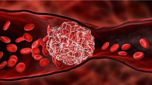 Covid-19 : le risque de caillots sanguins et d’évènements graves liés augmente après l’infection