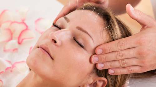 L’acupuncture peut réduire efficacement les maux de tête chroniques