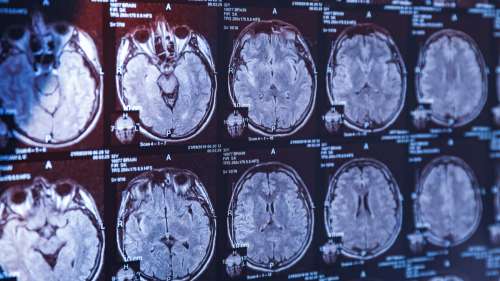 La maladie d’Alzheimer pourrait finalement ne pas être une maladie du cerveau