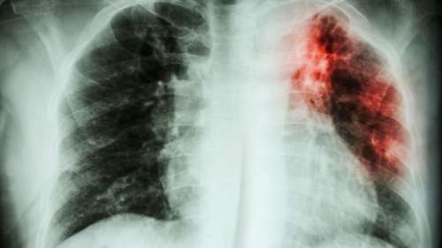 Le nombre de décès liés à la tuberculose augmente pour la première fois en 20 ans