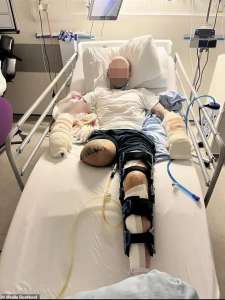 Un homme de 28 ans a été amputé d’une jambe et son partenaire a perdu des doigts après une “attaque à la machette”