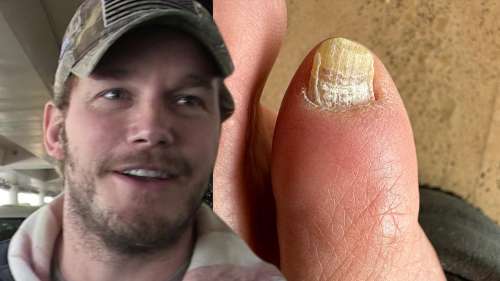 Chris Pratt a reçu un diagnostic de mycose des orteils par le docteur “Mes pieds me tuent”