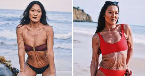 Voici l’histoire de Sara Geurts, un mannequin de 31 ans atteint d’une maladie de peau rare