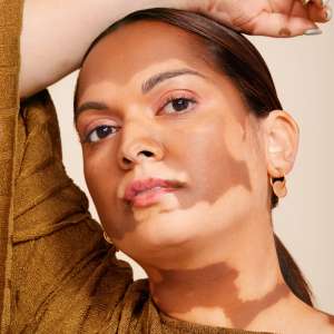 Qu’est-ce que le vitiligo ?  Un dermatologue explique l’état de la peau