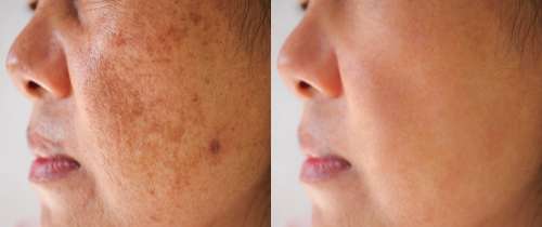 Le sérum Urban Skin Rx a aidé 90 % des utilisateurs à réduire les taches brunes